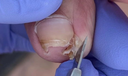 甲沟炎修脚视频,专业指导，轻松告别脚部困扰